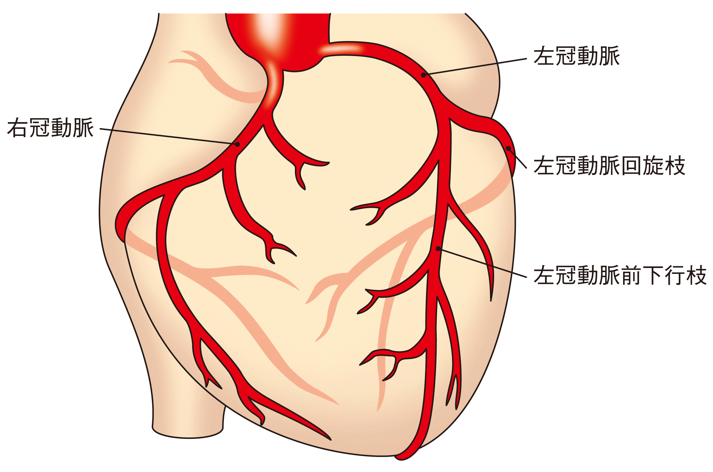 右心筋症とは何ですか?